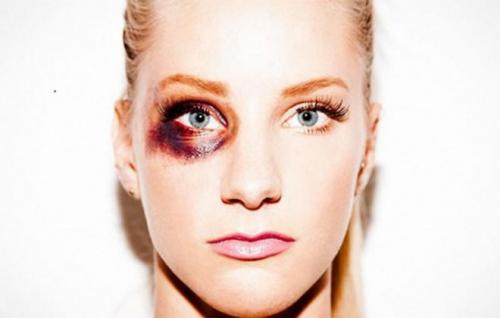 Убрать синяк за 1 день. Как быстро убрать (избавиться) синяк (гематому) за один день