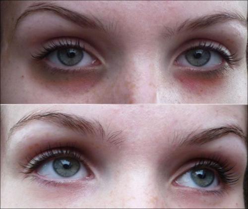 Как убрать мешки под глазами навсегда. Как быстро убрать или замаскировать мешки под глазами