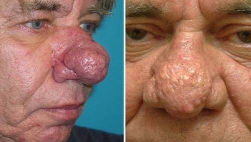 Покраснение на лице возле носа. Покраснение и шелушение вокруг носа: какие факторы провоцируют симптом, и как от него избавиться?