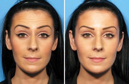 Можно ли докалывать ботокс через месяц. Как часто можно и нужно колоть препараты ботулотоксинов?