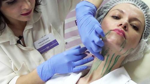 Можно ли докалывать ботокс через месяц. Как часто можно и нужно колоть препараты ботулотоксинов?