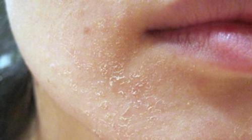 Раздражение на лице покраснение и шелушение. Причины раздражения, шелушения и зуда лица, лучшие мази для лечения