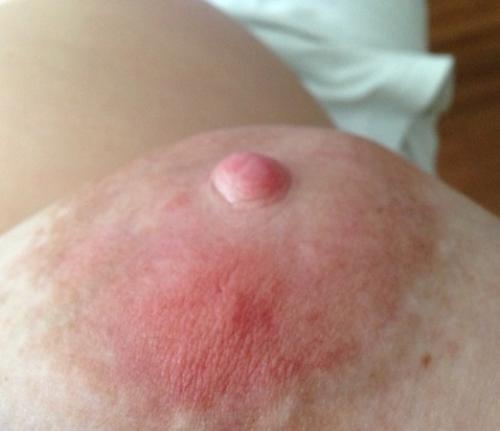 Корочка на ореоле соска. Красные пятна