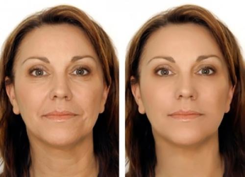 Косметические процедуры для омоложения лица после 50 лет. Мезотерапия 01