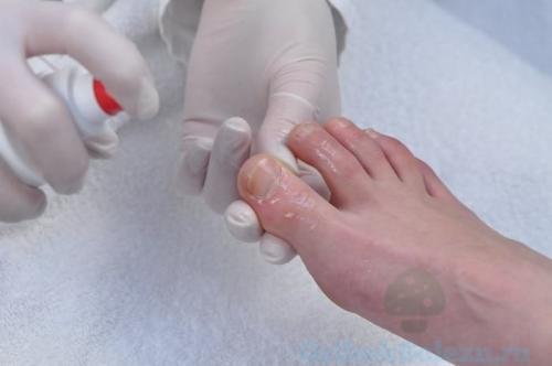 Как лечить грибок ногтей на ногах запущенный. Лечение
