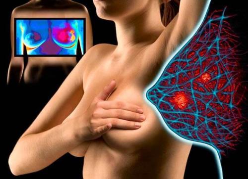 Фиброзно-кистозная мастопатия лечение. Cимптомы фиброзно-кистозной мастопатии молочных желез и как лечить заболевание