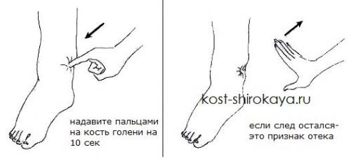Как снять отечность тела быстро. Определение