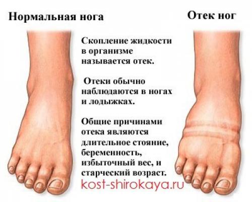 Как снять отечность тела быстро. Определение