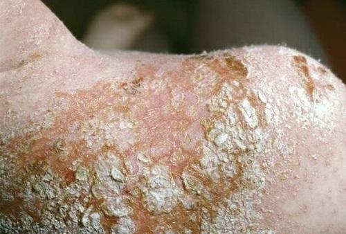 Нужна ли диета при стрептодермии. Симптомы и разновидности стрептодермии