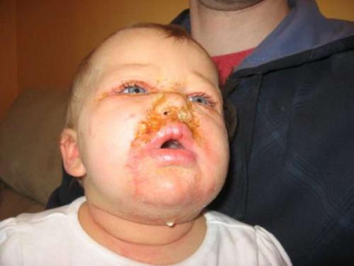 Амоксициллин при стрептодермии. Применение лекарственных препаратов с содержанием антибиотиков при стрептодермии