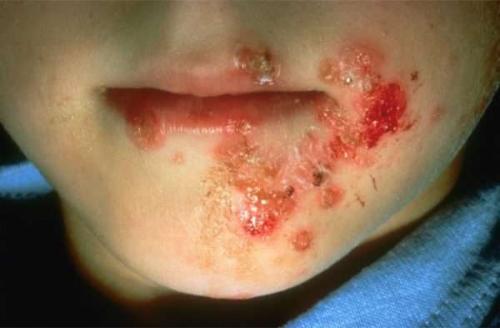 Амоксициллин при стрептодермии. Применение лекарственных препаратов с содержанием антибиотиков при стрептодермии