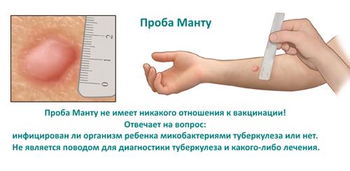 После манту, что делать. Что такое туберкулиновая проба