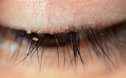 Фруктоза при демодекозе. Лечебная диета при демодекозе лица с таблицей разрешенных и запрещенных продуктов питания