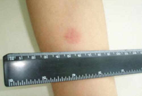 После манту, что можно делать. Проба Манту: что нельзя, а что можно?