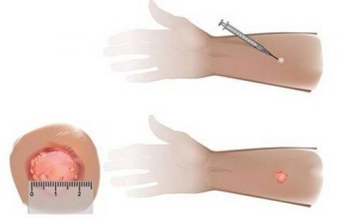 После манту, что может быть. Положительная реакция Манту: причины, что это означает и дальнейшие действия