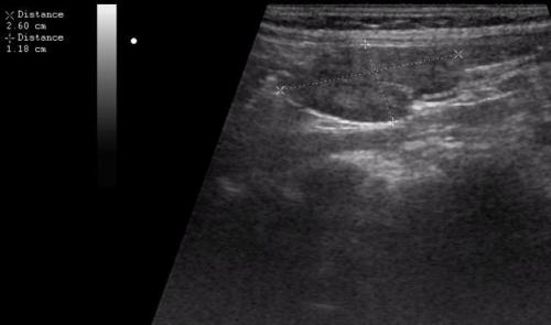 Мезаденит на узи. Диагностика