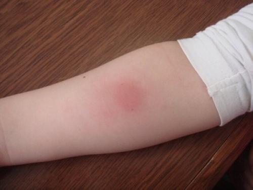 После манту, что может быть. Положительная реакция Манту: причины, что это означает и дальнейшие действия