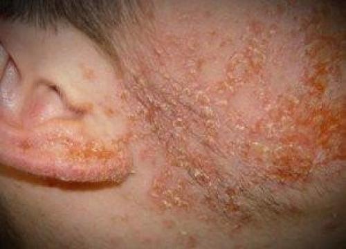 Как быстро вылечить стрептодермию