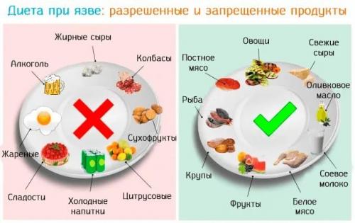 Что нельзя есть при язве желудка список продуктов. Запрещенные продукты