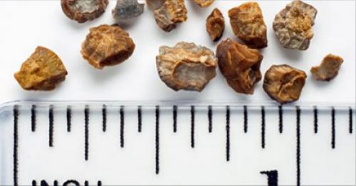 Фосфатурия диета у детей. Лечебная диета при фосфатных камнях в почках: правильное питание для растворения фосфатов 04