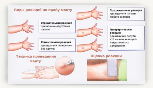 Сколько дней нельзя есть сладкое после Манту. Требования здравоохранения