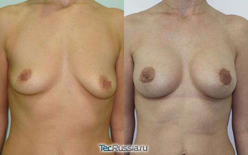 Периареолярная мастопексия подтяжка молочных желез трансареолярным способом. Что такое периареолярная подтяжка груди и как делают эту операцию 01 Периареолярная мастопексия подтяжка молочных желез трансареолярным способом. Что такое периареолярная подтяжка груди и как делают эту операцию 01