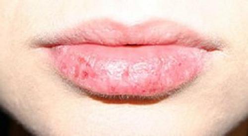 Сохнут и трескаются губы причина. Сохнут и трескаются губы 14 Сохнут и трескаются губы причина. Сохнут и трескаются губы 14