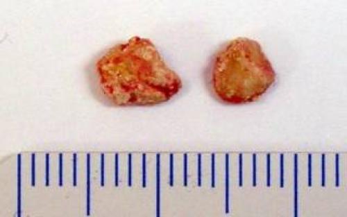 Чем опасен камень в слюнной железе. Характерные черты патологии