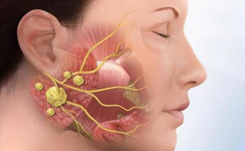 Чем опасен камень в слюнной железе. Характерные черты патологии