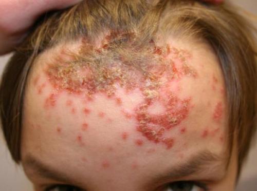 Стрептодермия у взрослых, как передается. Как начинается и передается стрептодермия у взрослых — лечение и фото