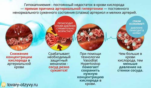 Hypertostop лекарство от гипертонии развод форум. В чем особенность препарата