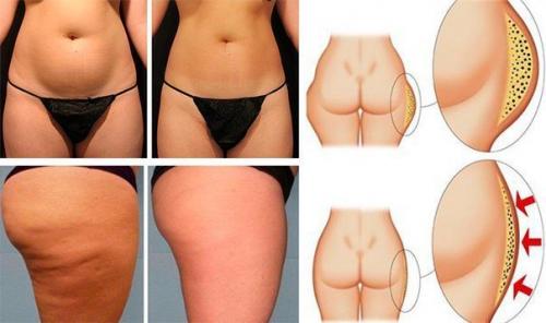 Как накачать ушки на бедрах. Как убрать ушки на бедрах за 2 недели: лучшие упражнения для дома и зала