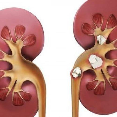 Диета при оксалатах таблица. Что провоцирует болезнь