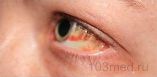 Сосуды полопались в глазах почему. Почему лопнул сосуд в глазу – причины и как лечить