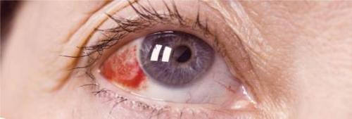 Сосуды полопались в глазах почему. Почему лопнул сосуд в глазу – причины и как лечить