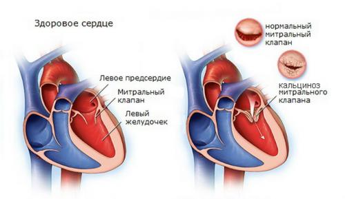 Отложение кальция в сосудах. Симптоматика кальцификации сосудов