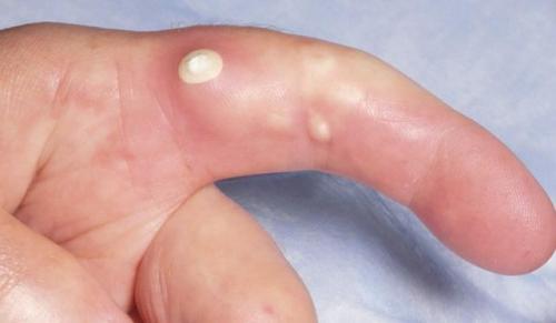 Отложение кальция в сосудах. Симптоматика кальцификации сосудов 04