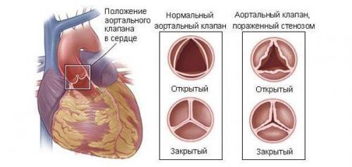 Кальциноз таблетки. Кальциноз сосудов: суть, виды, причины, симптомы