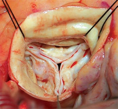 Диета при кальцинозе сердца. Диета больных кальцинозом аортального клапана 05
