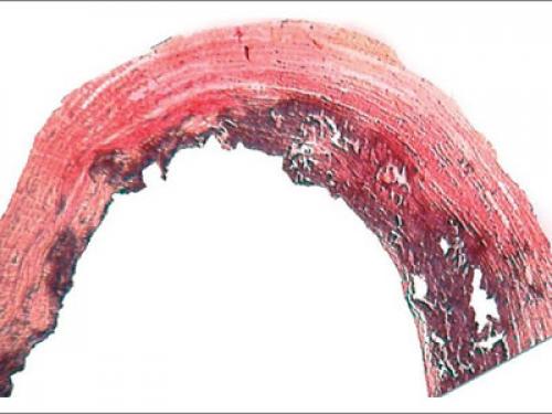 Диета при кальцинозе сердца. Диета больных кальцинозом аортального клапана