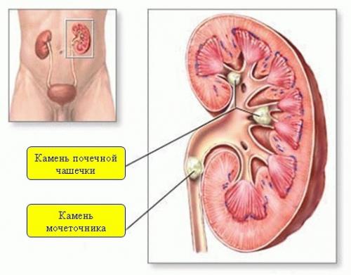 Чеснок при уратах. Какую опасность несут уратные камни в почках