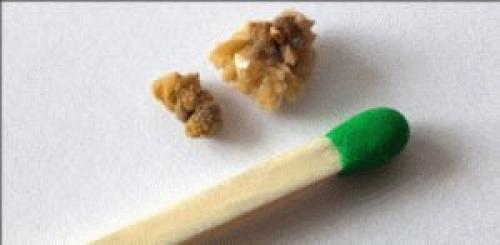 Кальция оксалат моногидрат. Кальцийсодержащие