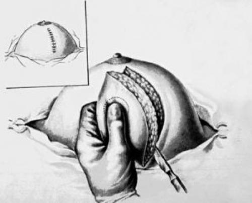 Негормональные препараты от мастопатии. Варианты терапии