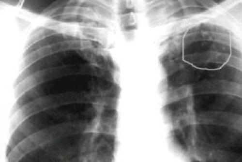 Кальциноз легких. Кальцинаты в легких у взрослых и детей