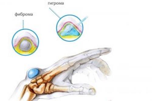 На пальцах рук шишки с жидкостью. Терапевтические манипуляции