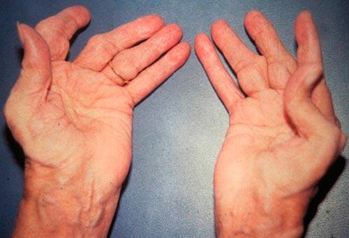 Возникающими на ранней стадии ревматоидного артрита становятся стирание хрящевой ткани. Что такое ревматоидный артрит?