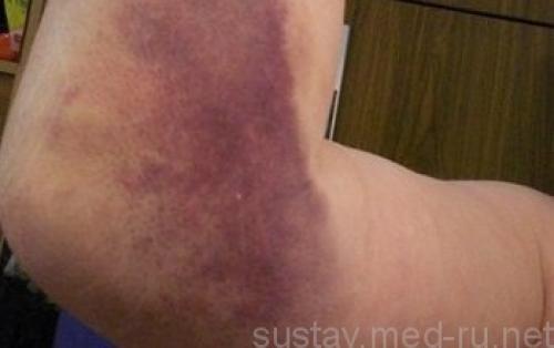 После ушиба болит локоть, что делать. Что делать при ушибах локтя при падении — симптомы и лечение