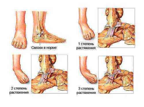 Сколько связки заживают. Заключение