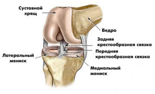 Разрыв медиального мениска коленного сустава операция. Симптомы повреждения мениска