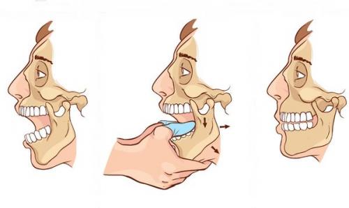Смещение челюстного сустава лечение. Причины воспаления
